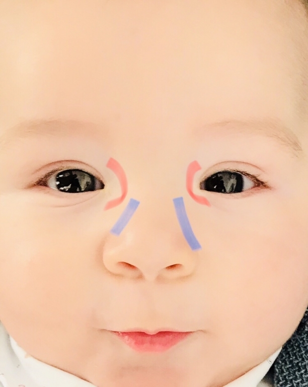 Massage des bavures des yeux chez les bébés