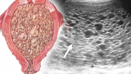 Qu'est-ce que la grossesse taupe (grossesse de raisin), quels sont les symptômes? Comment comprendre la grossesse taupe?