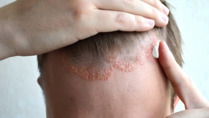 Quels sont les symptômes de la dermatite séborrhéique et qui apparaît-elle? Les aliments qui déclenchent la maladie