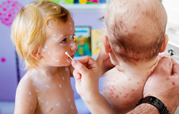 Les symptômes de la varicelle dans la petite enfance et l'enfance