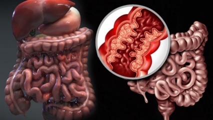 Qu'est-ce que la maladie de Crohn? Quels sont les symptômes de la maladie de Crohn? Existe-t-il un remède pour Crohn?