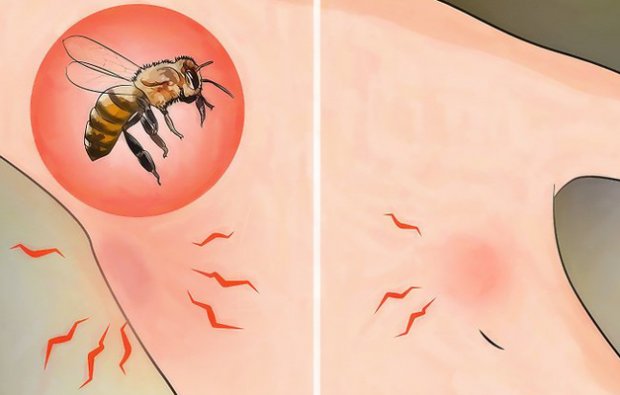 Qu'est-ce que l'allergie aux abeilles et quels sont les symptômes? Des méthodes naturelles bonnes pour les piqûres d'abeilles