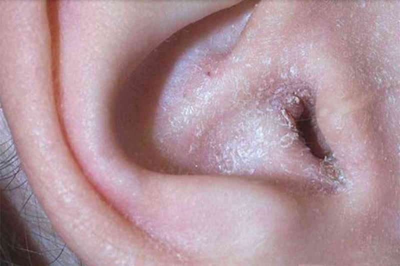 Qu'est-ce qui cause le pelage derrière l'oreille et comment ça passe? La solution définitive pour l'eczéma derrière l'oreille ...