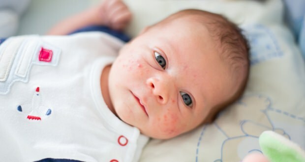 Pourquoi l'acné survient-elle chez les bébés?