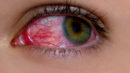 Qu'est-ce qui cause une allergie oculaire? Quels sont les symptômes de l'allergie oculaire? Qu'est-ce qui est bon pour les allergies oculaires? 