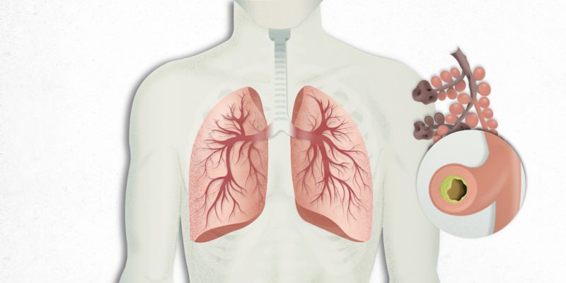 le virus qui s'installe dans les poumons est mélangé à une pneumonie
