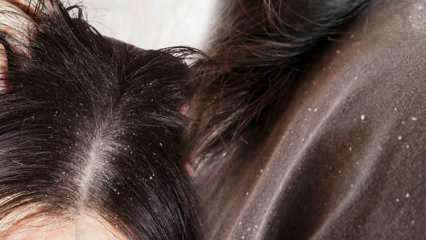 Comment les pellicules passent-elles et qu'est-ce qui est bon pour les cheveux pelliculaires? 5 méthodes d'élimination des pellicules les plus rapides et les plus efficaces