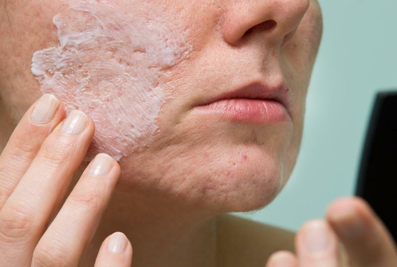 Quelles sont les causes de l'acné enflammée et comment disparaît-elle? Masque qui sèche l'acné enflammée