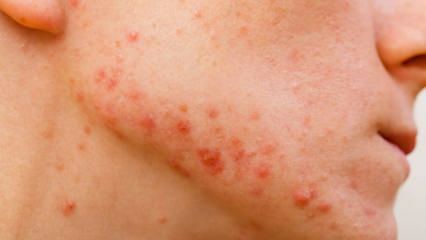 Comment l'acné kystique passe-t-elle? Qu'est-ce qui est bon pour l'acné kystique?