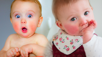 Attention aux bébés aux joues rouges! Syndrome des joues giflées et ses symptômes