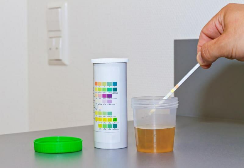 le niveau de bilirubine se produit généralement dans le test d'urine