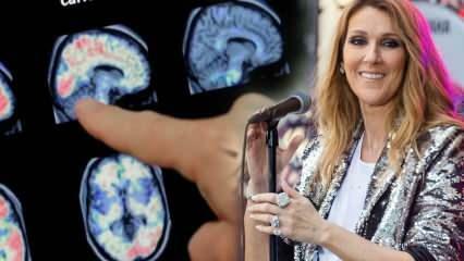 Qu'est-ce que le syndrome de la personne raide? Céline Dion