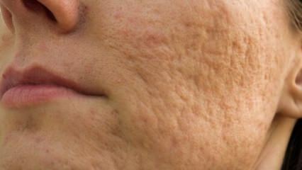 Comment vont les cicatrices d'acné sur le visage? Recettes de masque qui éliminent les cicatrices d'acné