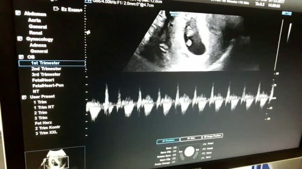 Quand le rythme cardiaque du bébé dans l'utérus est-il entendu? Si le rythme cardiaque du bébé n'est pas entendu ...