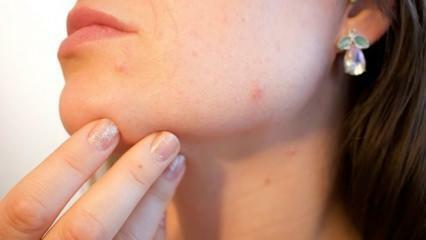 Qu'est-ce que le cancer de la peau (mélanome)? Quels sont les symptômes du mélanome et existe-t-il un remède ?