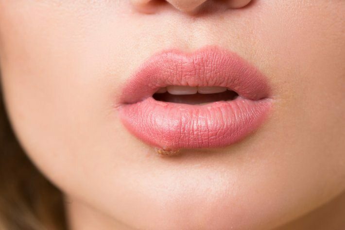 Qu'est-ce que le cancer de la langue? Quels sont les symptômes?