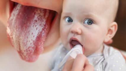 Symptômes et traitement du muguet chez les bébés! Comment est le muguet chez les bébés?