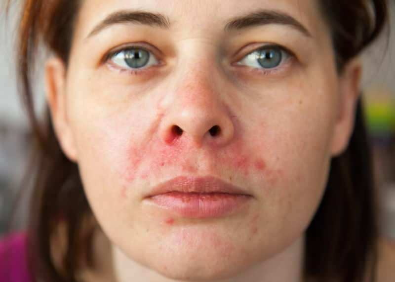 Pourquoi l'acné apparaît-elle autour de la lèvre? Comment traite-t-on la dermatite périorale?