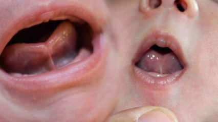 Quelle est la liaison de la langue (Ankyloglossi) chez les nourrissons? Symptômes et traitement du lien avec la langue ...