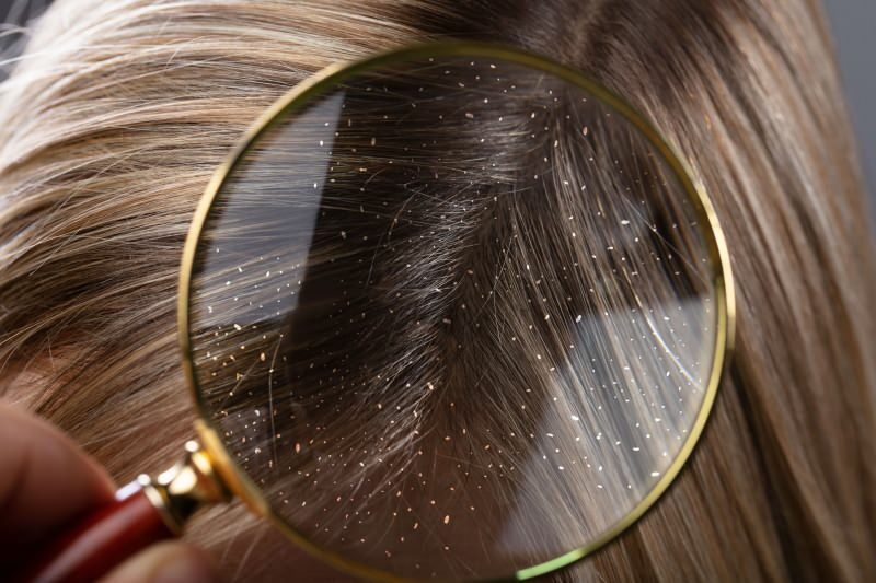 Comment les pellicules passent-elles et qu'est-ce qui est bon pour les cheveux pelliculaires? Les 5 remèdes antipelliculaires les plus rapides et les plus efficaces