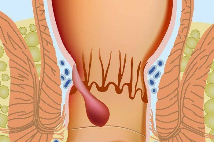 Comment les hémorroïdes se produisent dans la partie anale 