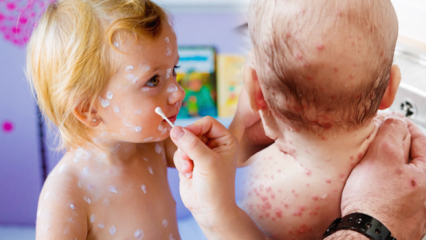 Comment comprendre la varicelle pendant la petite enfance et l'enfance? Symptômes et traitement de la varicelle
