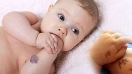Provoque une tache de naissance chez les bébés, est-elle permanente? Quels sont les types de taches de naissance? Cure de Saracoglu