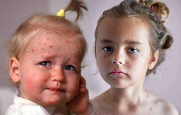 Comment comprendre la varicelle dans la petite enfance et l'enfance? Symptômes et traitement de la varicelle