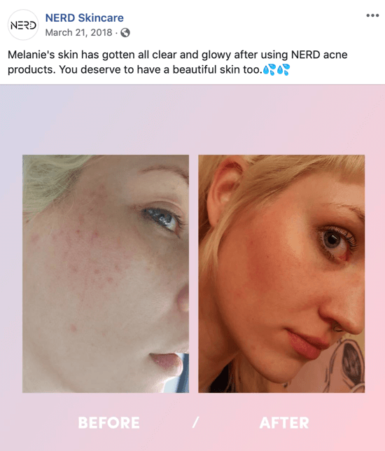 Exemple de la façon dont Nerd Skincare a utilisé une image avant-après pour créer une publication d'image pour les médias sociaux qui stimule les achats de leurs produits.