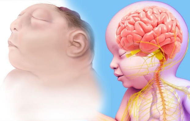 Anencephaly baby vit-il? Diagnostic anencéphale