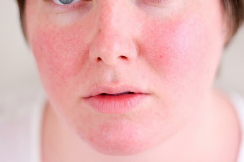 Comment passe le visage rougi? Les meilleurs produits de soin contre les rougeurs du visage