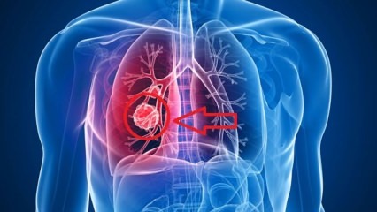 Symptômes du cancer du poumon: stades du cancer du poumon!