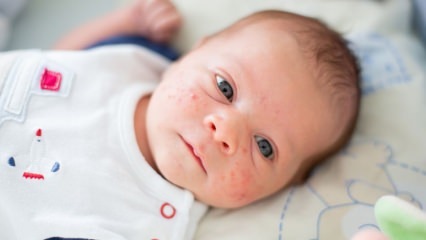 Comment vont les boutons sur le visage de bébé? Méthodes de séchage de l'acné (Milia)