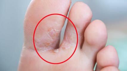 Qu'est-ce que le champignon du pied? Quels sont les symptômes du pied d'athlète? Traitement du pied d'athlète 