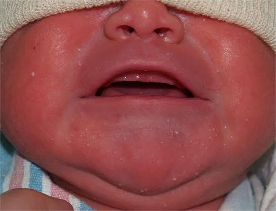 Pourquoi la tache blanche apparaît-elle chez les bébés?