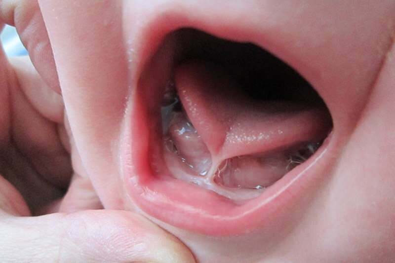 Symptômes et traitement du lien de la langue chez les nourrissons