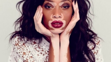 Qu'est-ce que le vitiligo (maladie de blanchiment)?