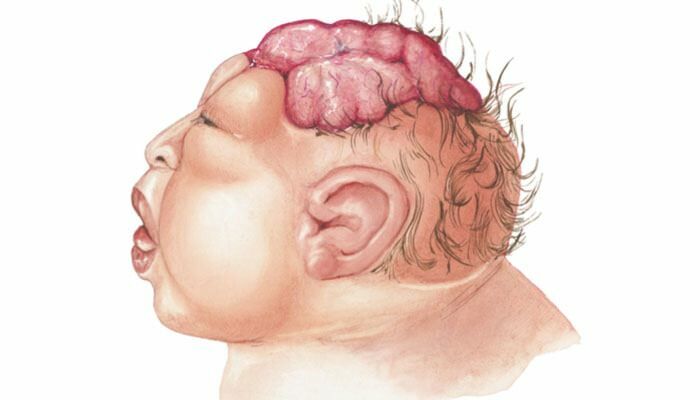 Qu'est-ce que l'anencéphalie? Quels sont les symptômes de l'anencéphalie chez les nourrissons et les enfants? L'anencéphalie provoque ...