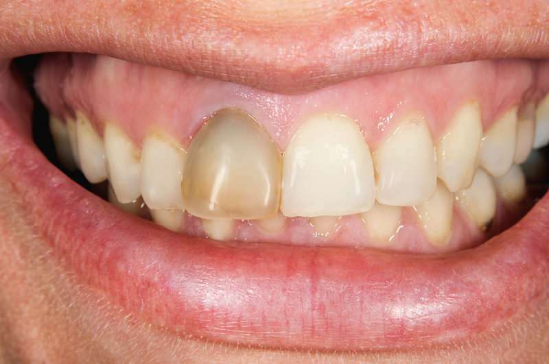 l'assombrissement des dents peut parfois se concentrer sur une seule dent