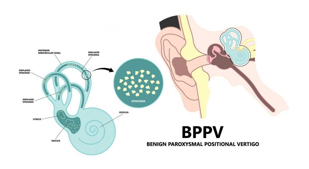 Pourquoi la tête tourne-t-elle en position couchée? Qu'est-ce qui est bon pour le vertige positionnel paroxystique bénin? Comment se débarrasser du VPPB