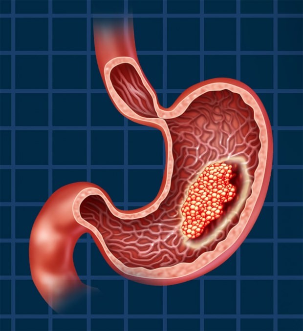 Comment se produit le cancer de l'estomac? Quels sont les symptômes du cancer de l'estomac? Existe-t-il un traitement contre le cancer de l'estomac?