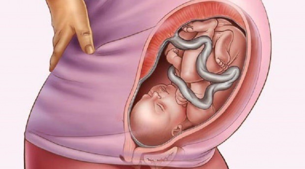 Qu'est-ce que le placenta previa?