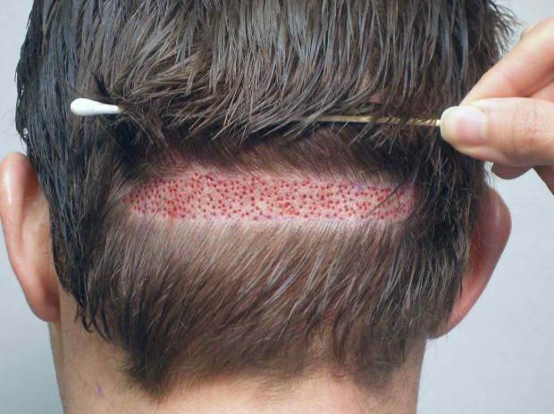 Qu'est-ce que la teigne (Alopecia areata)? Quels sont les symptômes de la teigne? Solutions efficaces pour la teigne