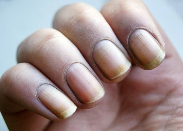 Pourquoi l'ongle jaunit-il? Comment blanchir les ongles qui jaunissent du vernis à ongles?