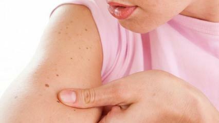 Qu'est-ce que le cancer de la peau (peau) et quels sont ses symptômes? Façons de comprendre le cancer de la peau