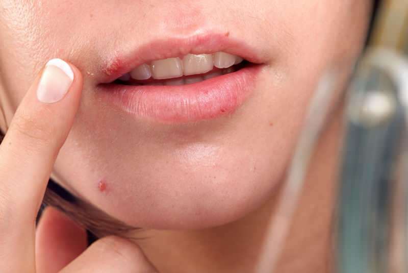 l'herpès sort généralement sur le bord de la lèvre.
