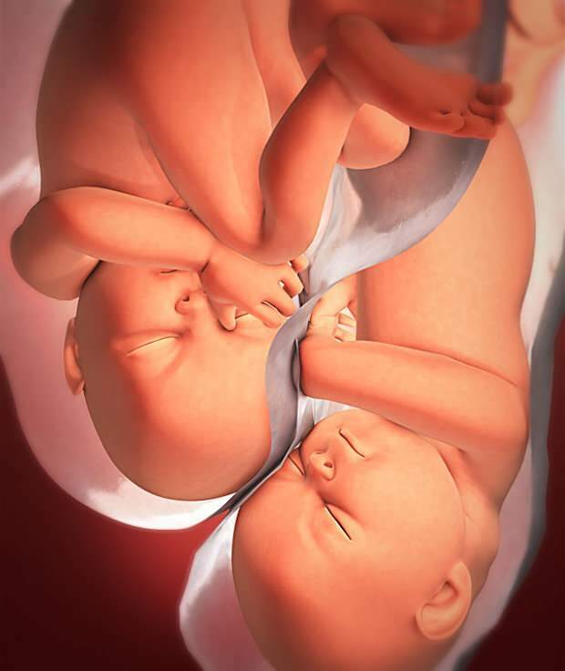Quels sont les symptômes d'une grossesse gémellaire?