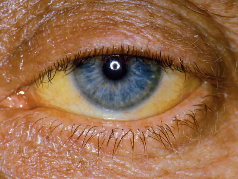la hauteur au niveau de la bilirubine provoque une coloration jaune sur les yeux et la peau