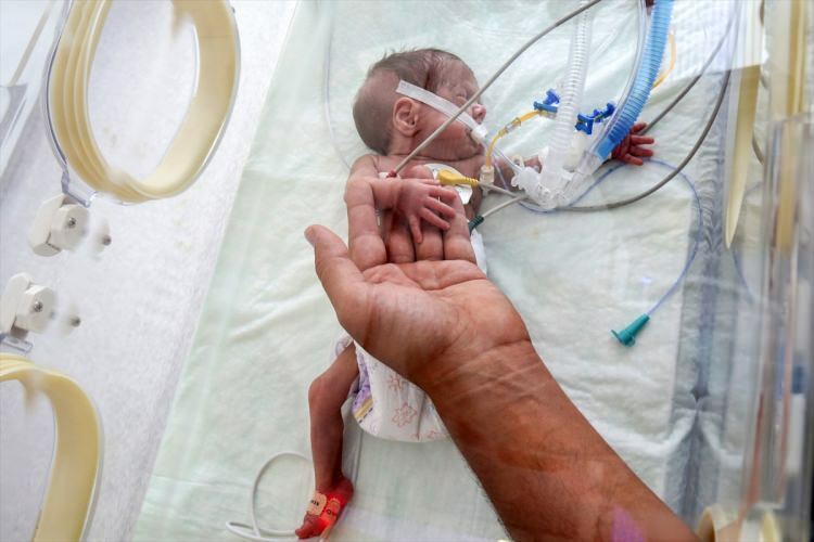 «Bébé miracle» a survécu à la chirurgie
