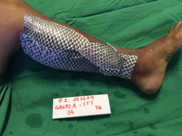 La peau de poisson est passée dans les antécédents médicaux dans le traitement des brûlures